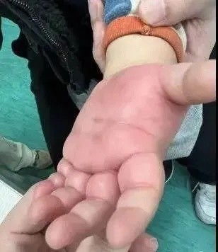 2岁女宝左手肿得像馒头,家人赶紧带去骨科医生建议去皮肤科