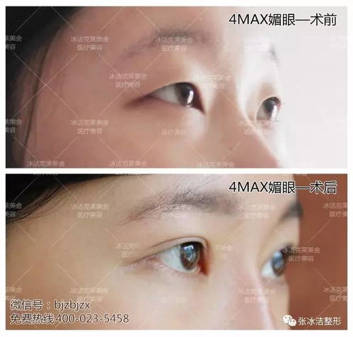 达康书记迷人的欧式双眼皮你也想要
