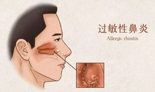 过敏性鼻炎只要吃药就能好别尽信