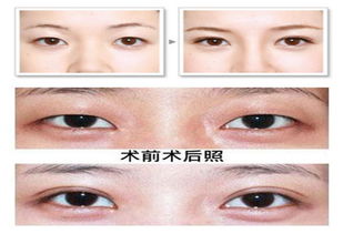 眼整形哈尔滨埋线双眼皮适合无肿眼泡眼皮松弛的mm微创恢复快悦美整形