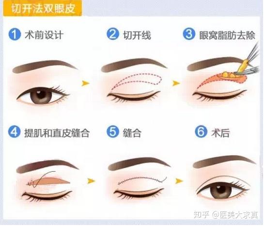 割双眼皮对外貌的改变大吗