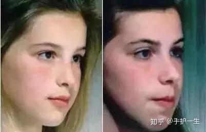 凸嘴龅牙...这个坏习惯可能让孩子越长越丑,现在改还来得及