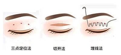 医美季01四种重睑术双眼皮,没有任何包装