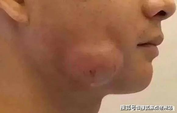 小伙脸上慢慢鼓起大包,去医院检查,拍完的片子让医生很意外