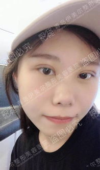 这位小姐姐在青岛做的5s双眼皮竟然这么自然