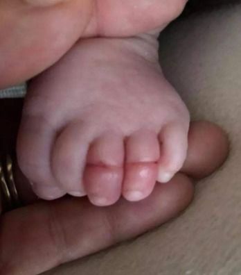 妈妈的疏忽害孩子小手肿成茄子,这种养娃疏忽危害大,谁也不要犯