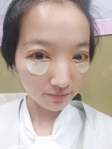 大眼有神,小眼迷离,又单又小的眼睛简直是颜值克星,...双眼皮悦美整形