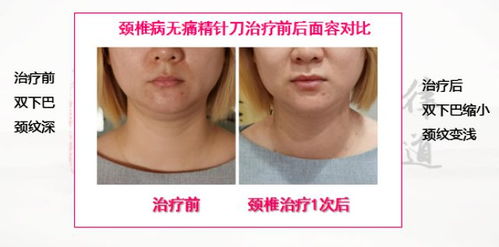 颈椎病与面容衰老的临床观察1