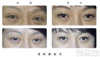 双眼皮可以修复吗