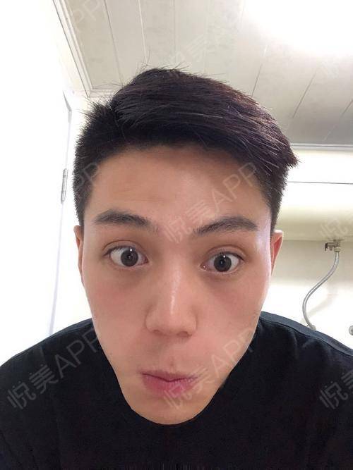 银海医美做双眼皮术后第82天今天我是谁我是表情丰...双眼皮悦美整形