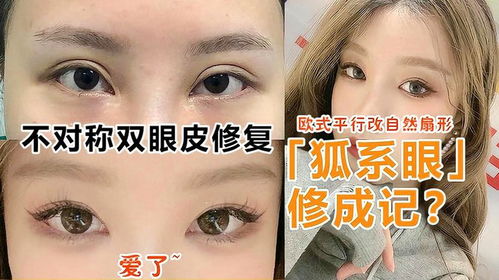 全切后不对称双眼皮修复欧式平行改扇形,这是狐系眼养成记