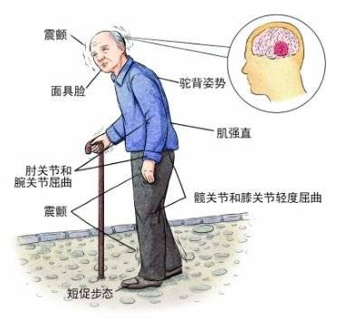 帕金森病有哪些症状,怎么发现怎么治都在这了
