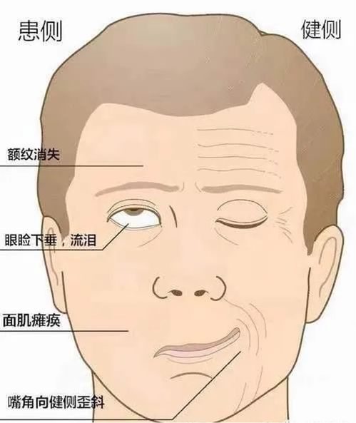 突然口歪眼斜流口水...很可能是面瘫了,怎么办
