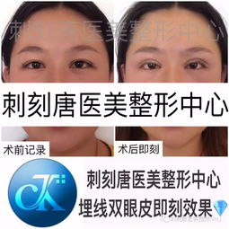 黑眼球被眼皮遮挡,应该割双眼皮还是切眉