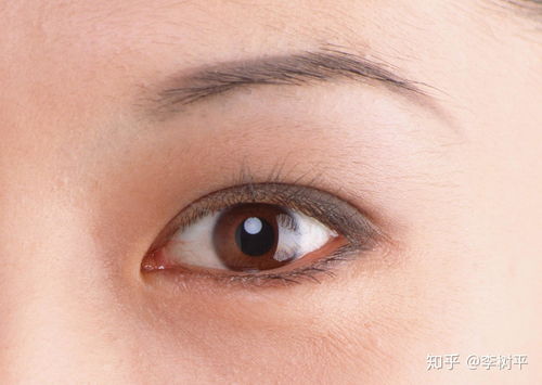 什么是超自然精准双眼皮