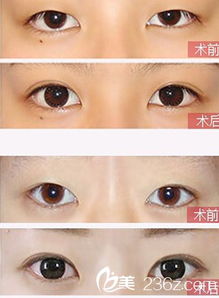 沈阳埋线双眼皮埋线双眼皮价低至1280元维持更久