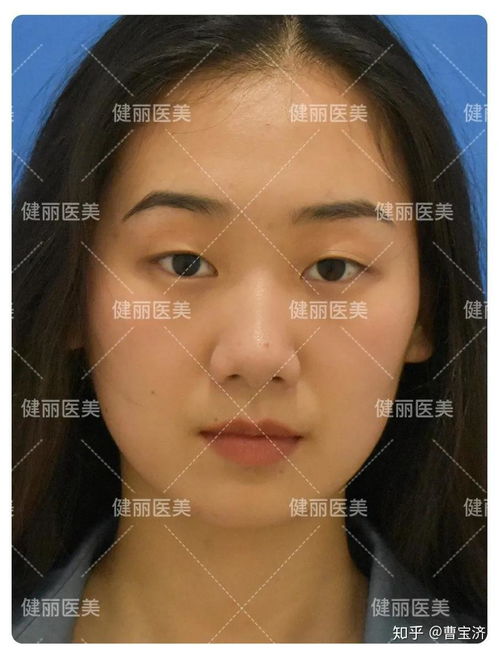 毕业就去做双眼皮,高中好友的表情亮了,这是