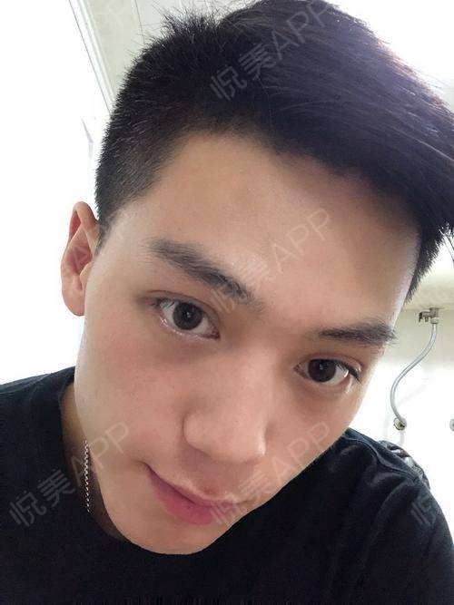 银海医美做双眼皮术后第82天今天我是谁我是表情丰...双眼皮悦美整形