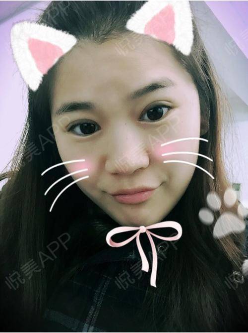 look不同角度不同表情,我的双眼皮也变化无常,这软...双眼皮悦美整形