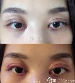 在韩国首尔江南三星医院做的埋线双眼皮内眼角提升价格七千左右很满意