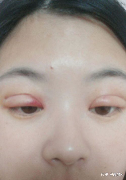 记录我的埋线双眼皮恢复过程