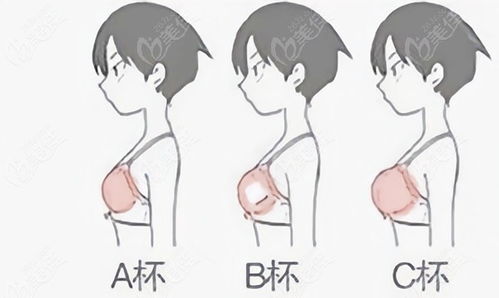 160165cm身高做隆胸选多大假体合适用250300350cc假体丰胸会太大吗