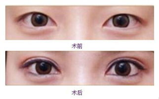 寒假肉毒素除皱腋臭微创治疗双眼皮优惠项目