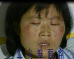二尖瓣面容
