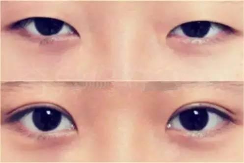 什么样的单眼皮才适合做双眼皮整形爱美的你绝对不能错过的知识