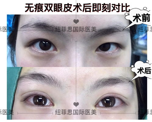 亚洲眼王徐在敦埋线双眼皮失败了多久能修复