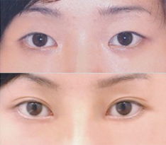 青岛韩式双眼皮需要多少钱