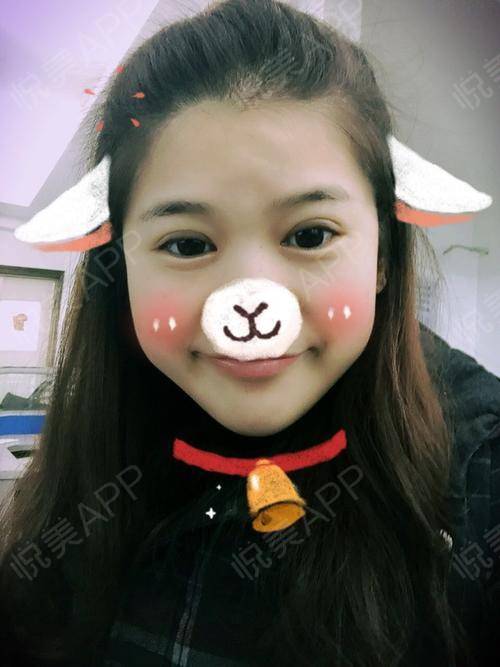 look不同角度不同表情,我的双眼皮也变化无常,这软...双眼皮悦美整形