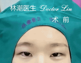 美呆25个双眼皮手术案例,拯救单眼皮